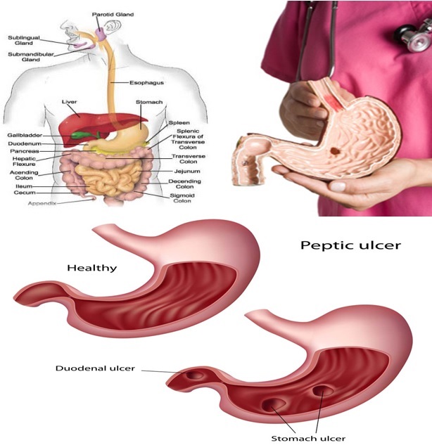 Guar Gum as an Effective Dietary Fiber in Reducing Stomach Ulcer