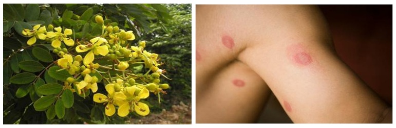 Cassia Tora- Consideration in Ayurvedic Medicine Systems