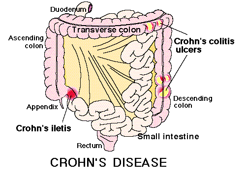 stomach and prevents indigestion, irritable bowel disease and Crohn’s disease